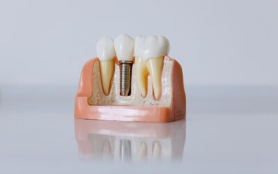 A Stronger Foundation: Understanding Dental Implants
